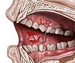 Protect yourself from Oral Cancer