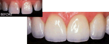 dental crowns before after