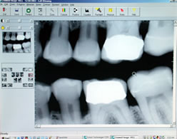 Dental digital xray
